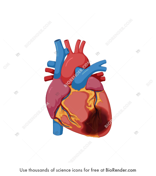 Heart (myocardial infarction) - Editable icon of a myocardial infarction of human heart with muscle damage and necrosis in the left ventricle