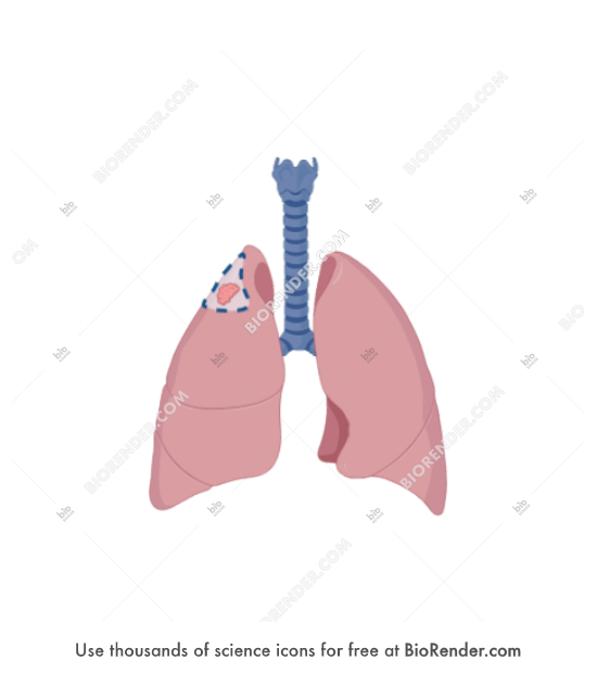 Free Lung Cancer Surgery wedge Resection Icons Symbols Images free-lung-cancer-surgery-wedge-resection-icons-symbols-images