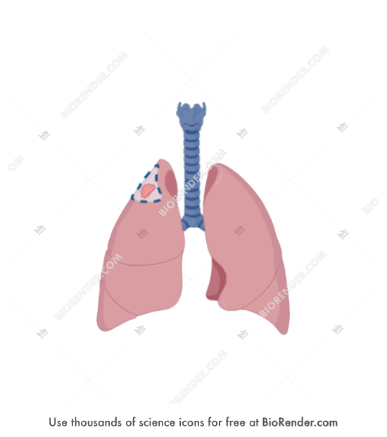 Lung cancer surgery (wedge resection) - Editable icon of A simplified representation of wedge resection lung cancer surgery