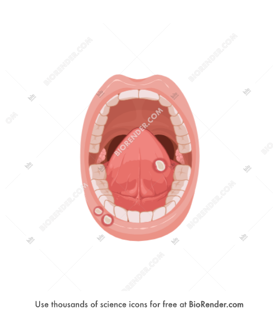 Free Oral ulcers Icons, Symbols & Images BioRender