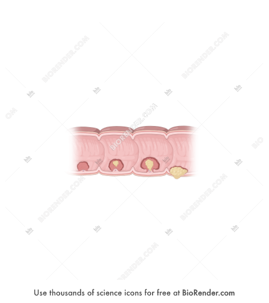 Large Intestine Cancer