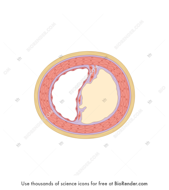 Atherosclerosis (molecular cross-section, 2. fibrous plaque) - Editable icon of A molecular cross section of a muscular artery with advanced atherosclerosis, showing a necrotic lipid core and fibrous cap