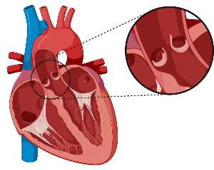 Aortic valve regurgitation 