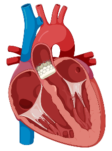 Heart (cross-section, with TAVR) 