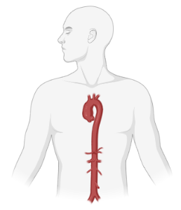 Adult (with aneurysm of ascending aorta)