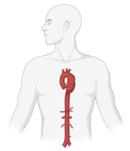 Adult (with aneurysm of descending thoracic aorta)