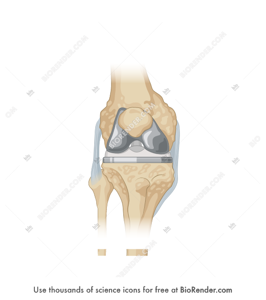 Free Total knee replacement (arthritis) Icons, Symbols & Images BioRender