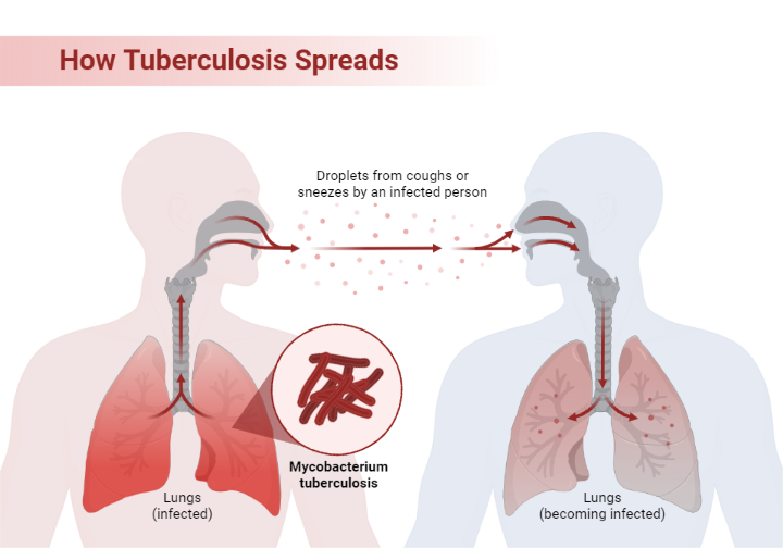 Image Result For Tuberculosis How Does It Spread And Whos At Risk Image Result For Tuberculosis How Does It Spread And Whos At Risk