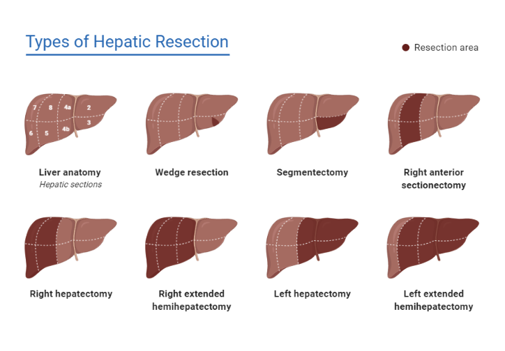 types-of-hepatic-resection-biorender-science-templates