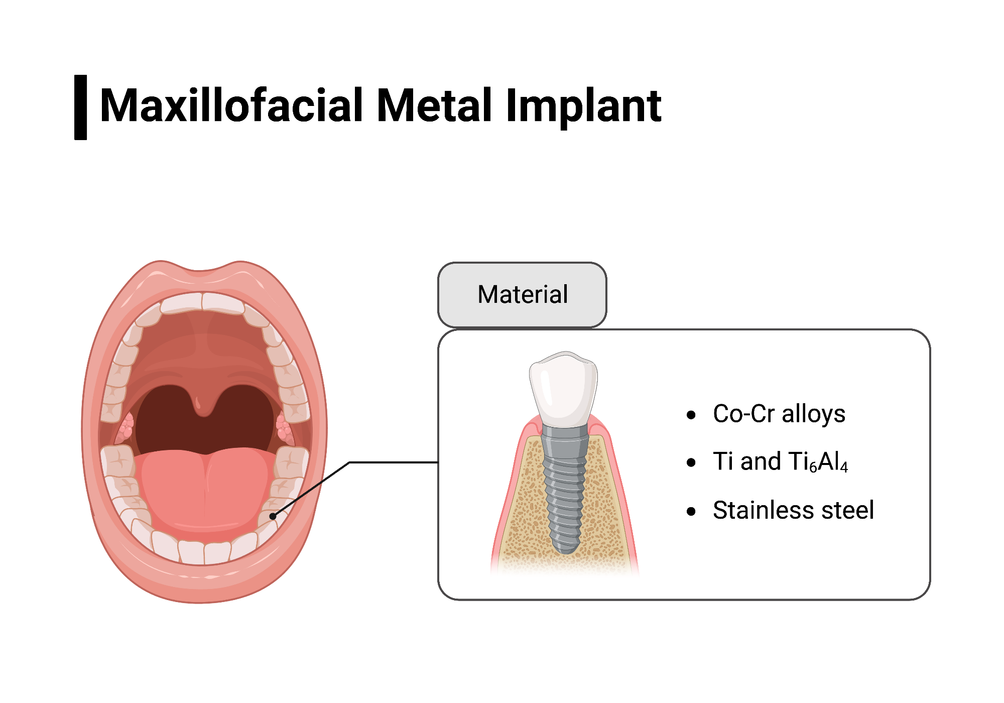 Maxillofacial Metal Implant BioRender Science Templates