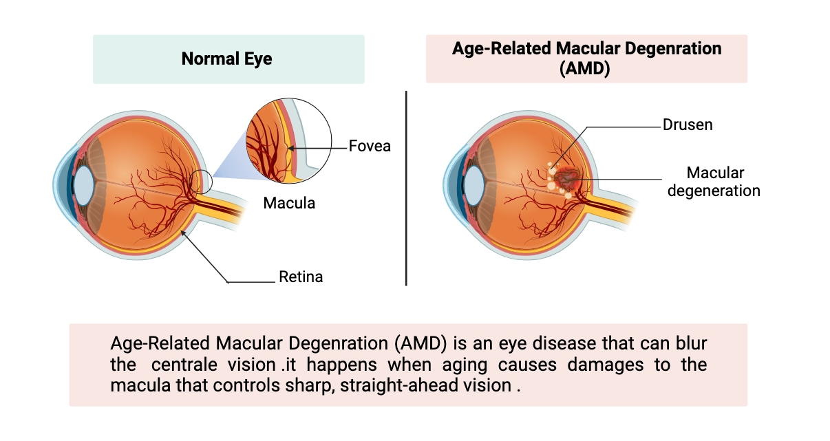 Age-Related Macular Degenration AMD | BioRender Science Templates
