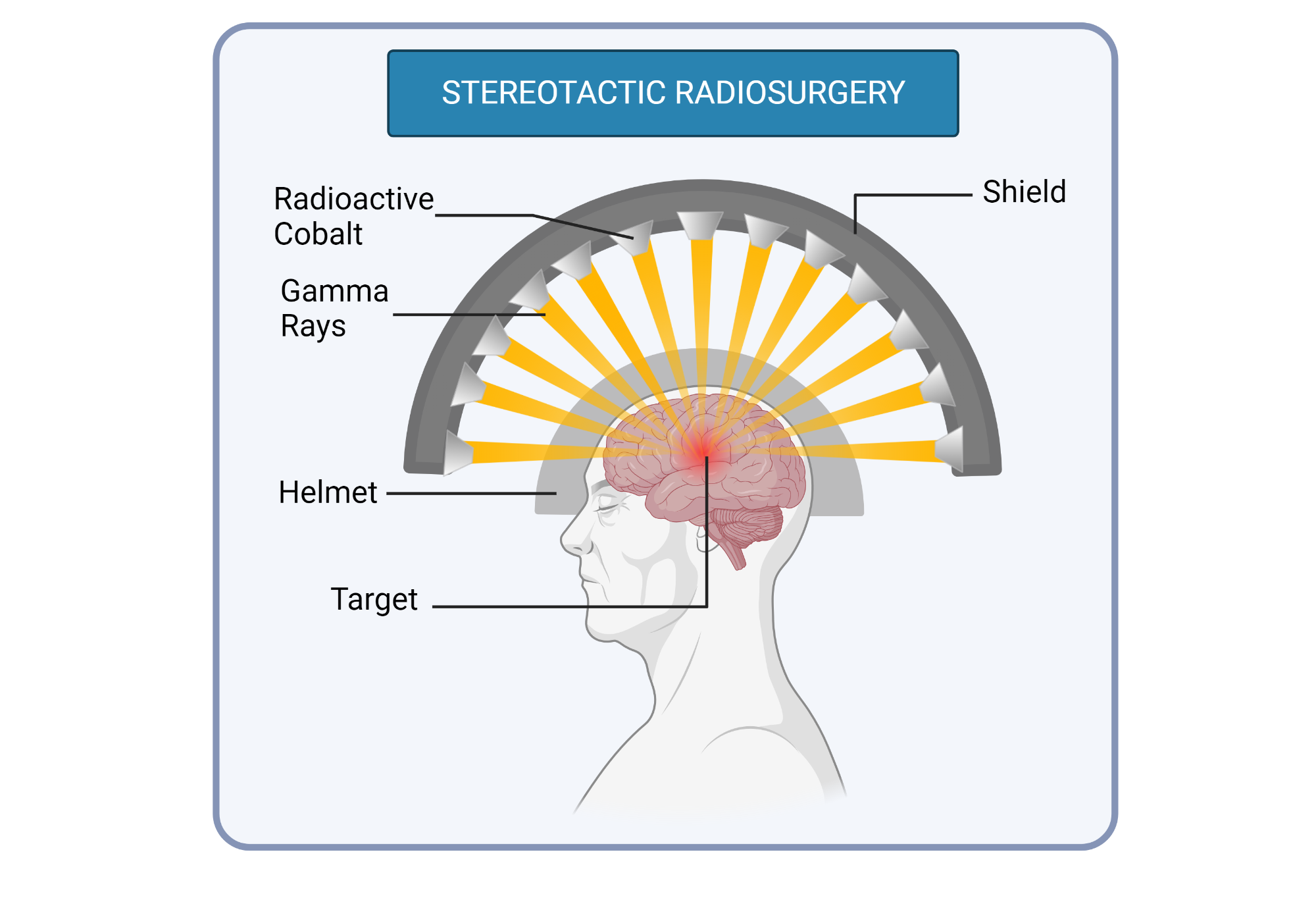 Stereotactic Radiosurgery Procedure With Radiation Beams BioRender