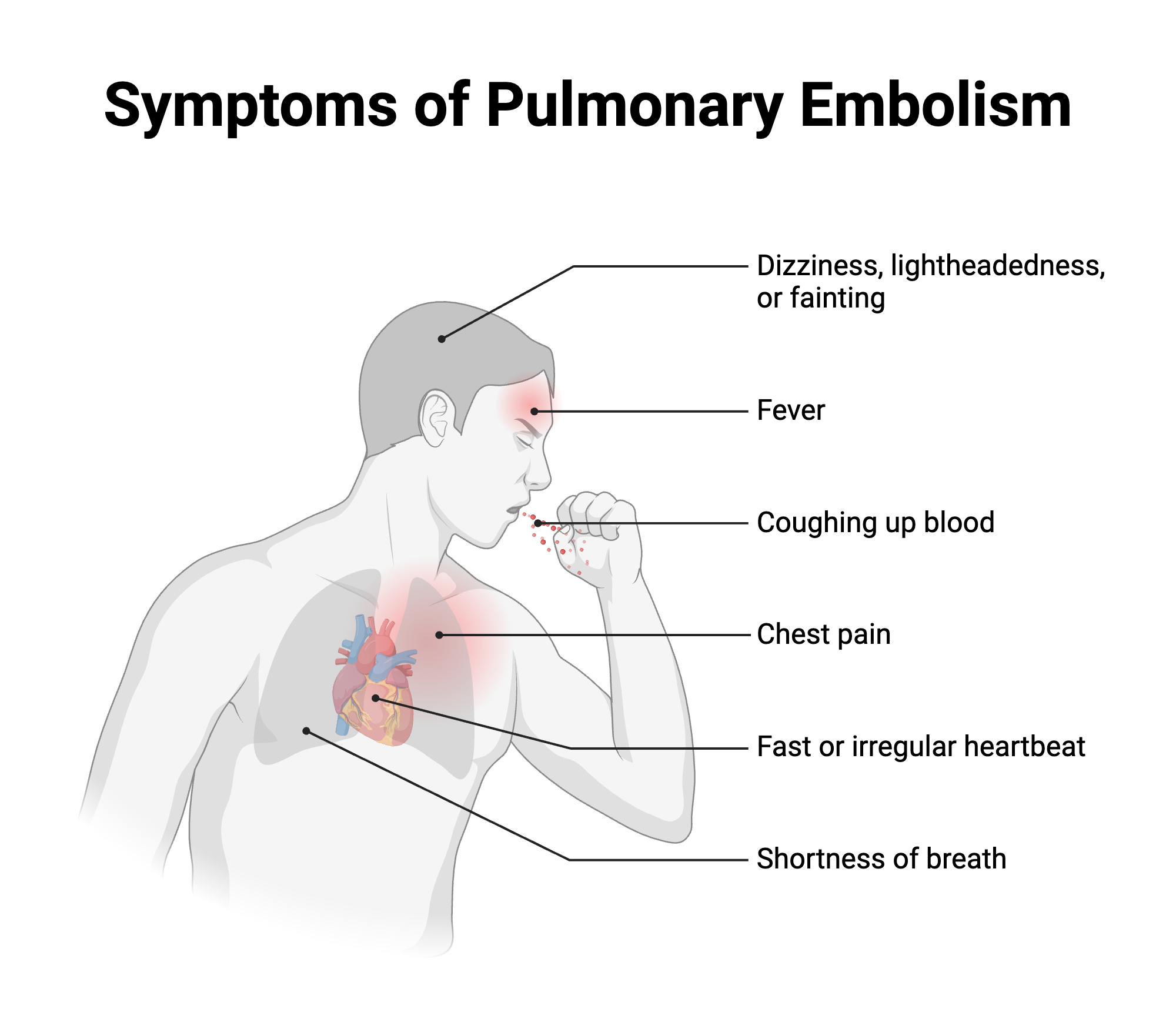 Symptoms Of Pulmonary Embolism BioRender Science Templates