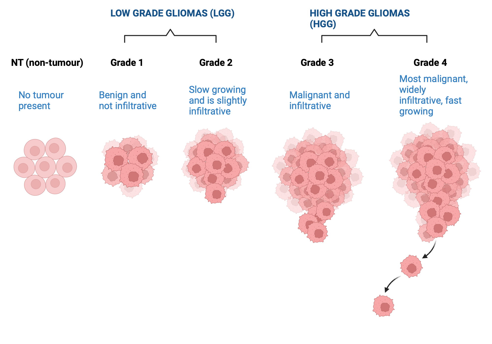 an-illustration-of-glioma-grades-and-their-typical-characteristics