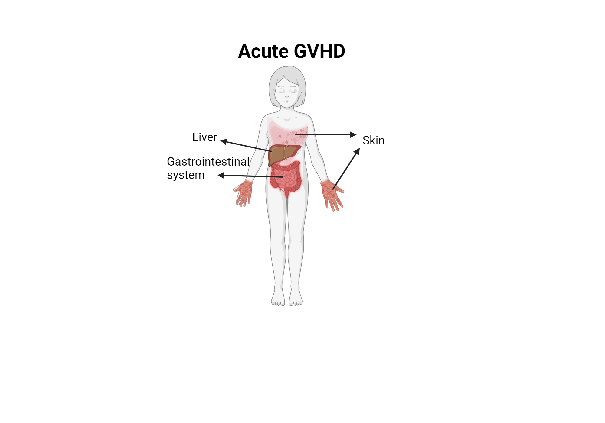 Acute GVHD Manifestation | BioRender Science Templates