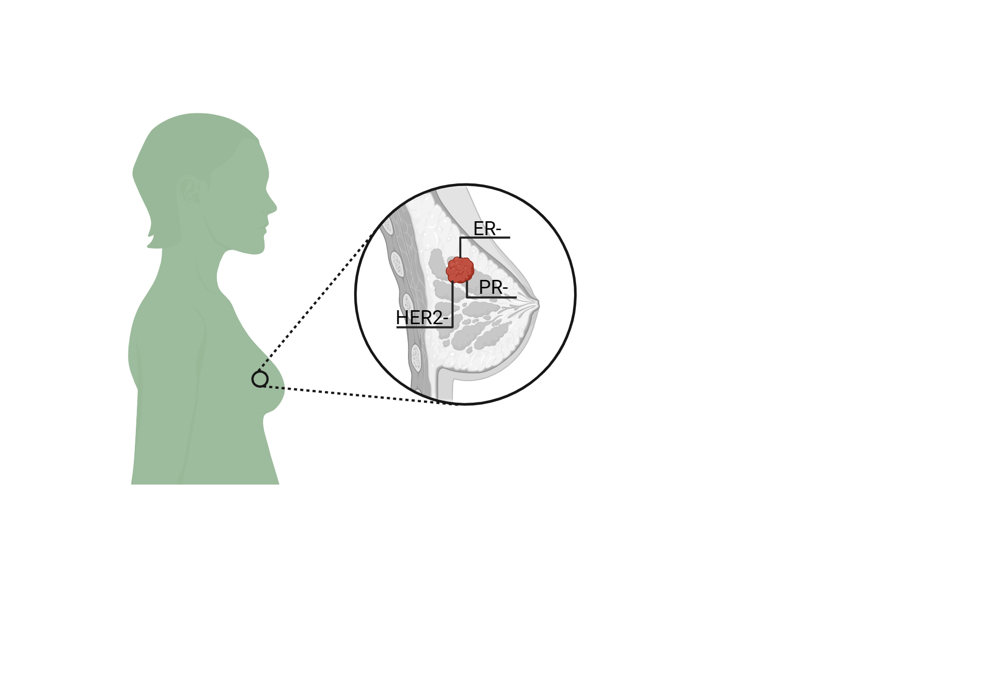 Triple Negative Breast Cancer Biorender Science Templates