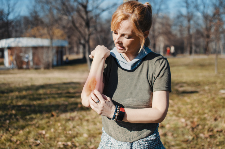 woman standing in a grassy area with winter trees in the background. She is scratching a blotchy rash on her arm