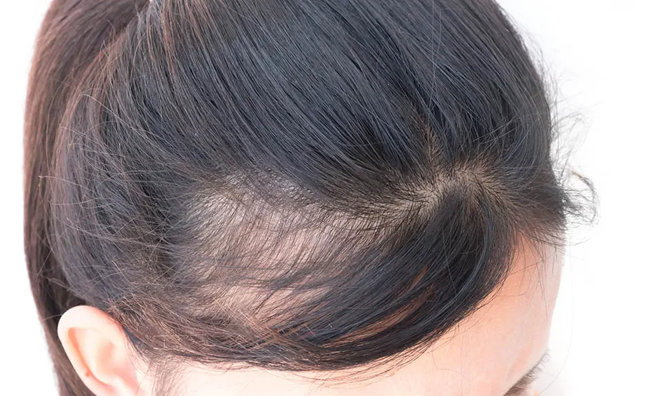 Does Dry Shampoo Cause Hair Loss 