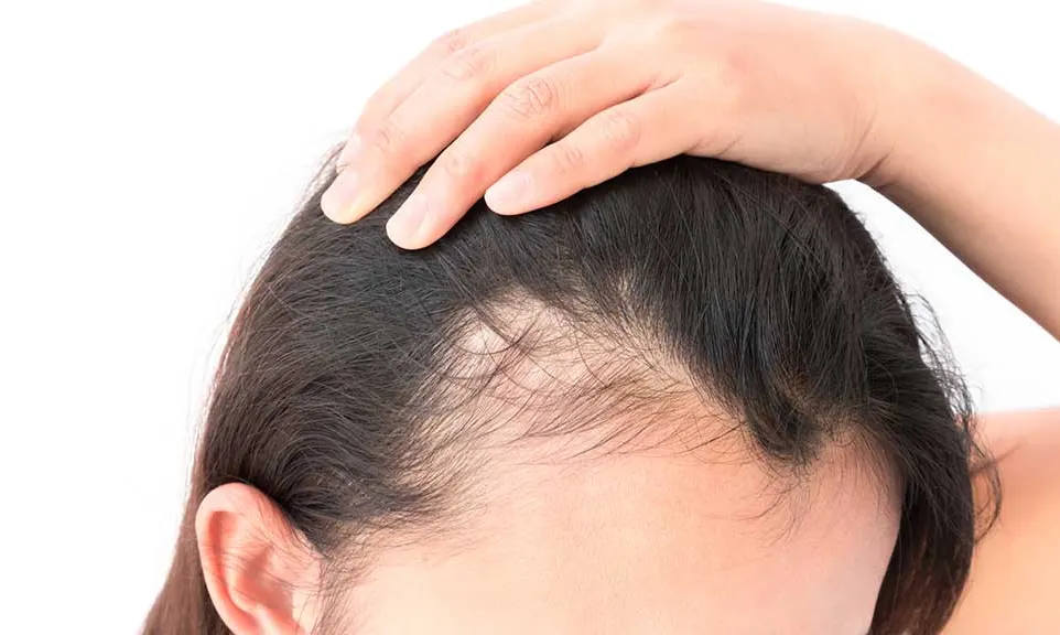 Understanding the Classification of Women’s Hair Loss