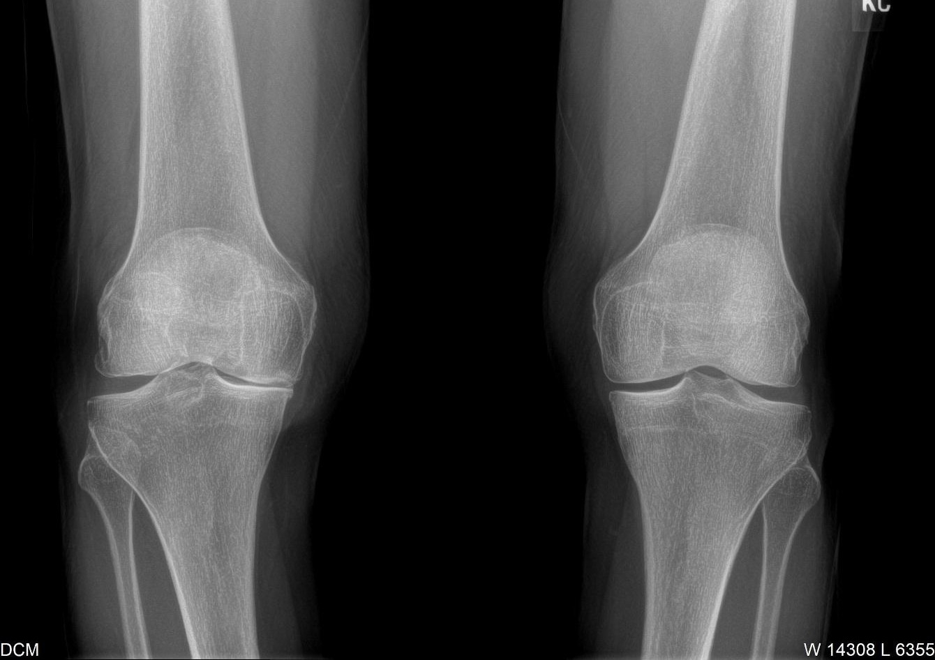 Arthritis Care