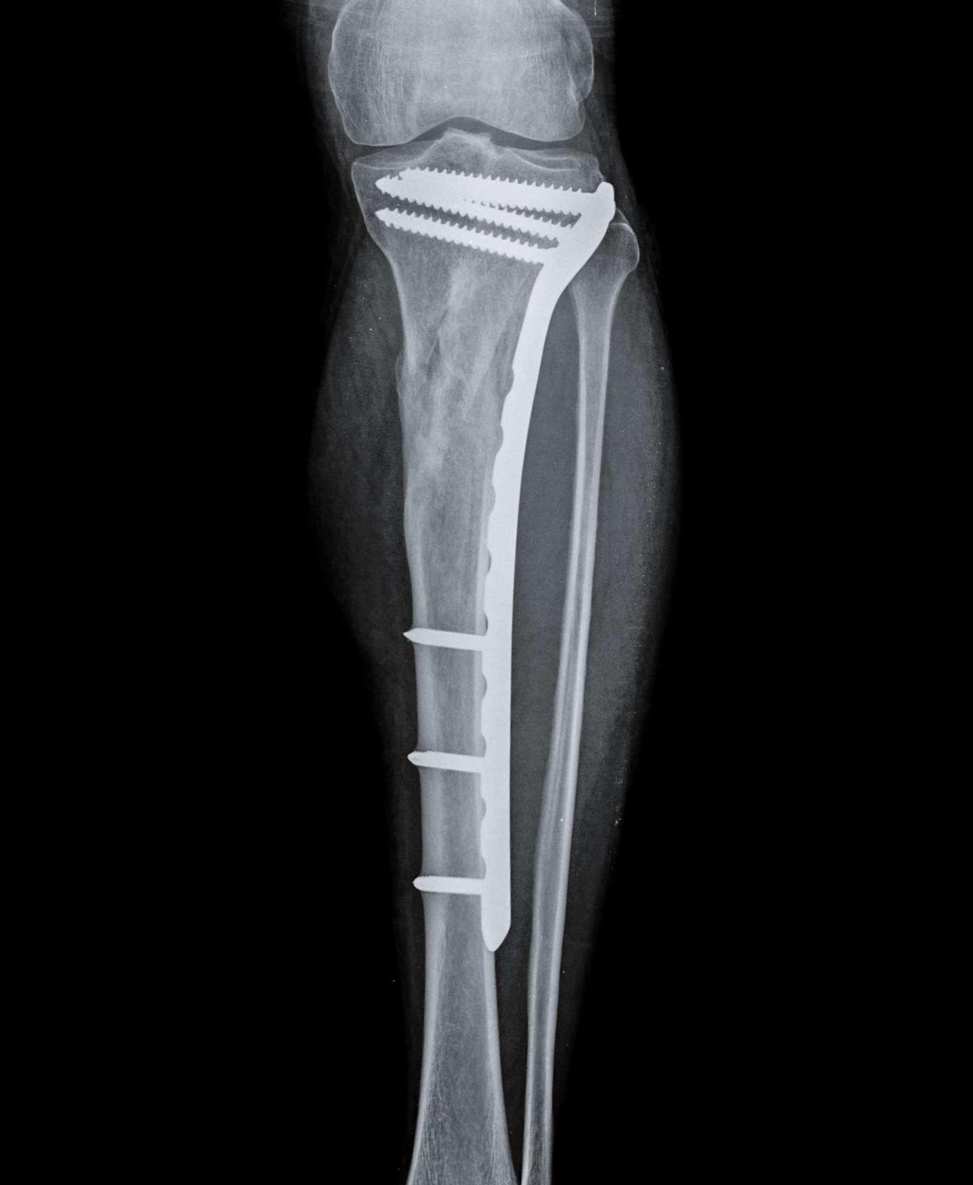 Trauma/Fracture (Broken Bone) Care
