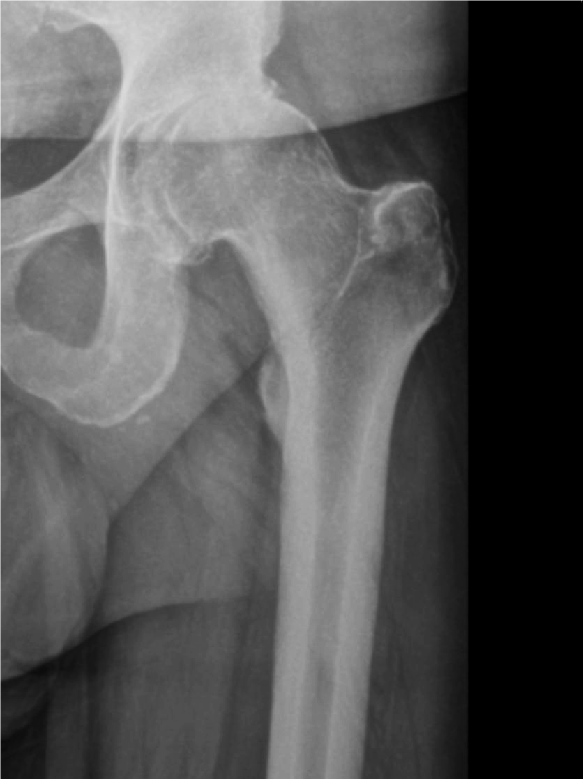 Hip Arthritis And Replacement