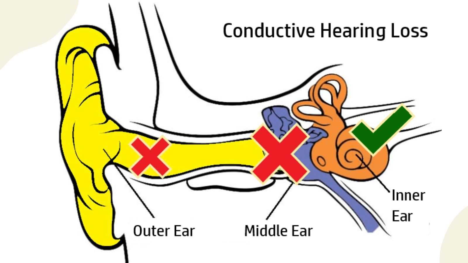 How to Identify a Conductive Hearing Loss (and What to do Next)