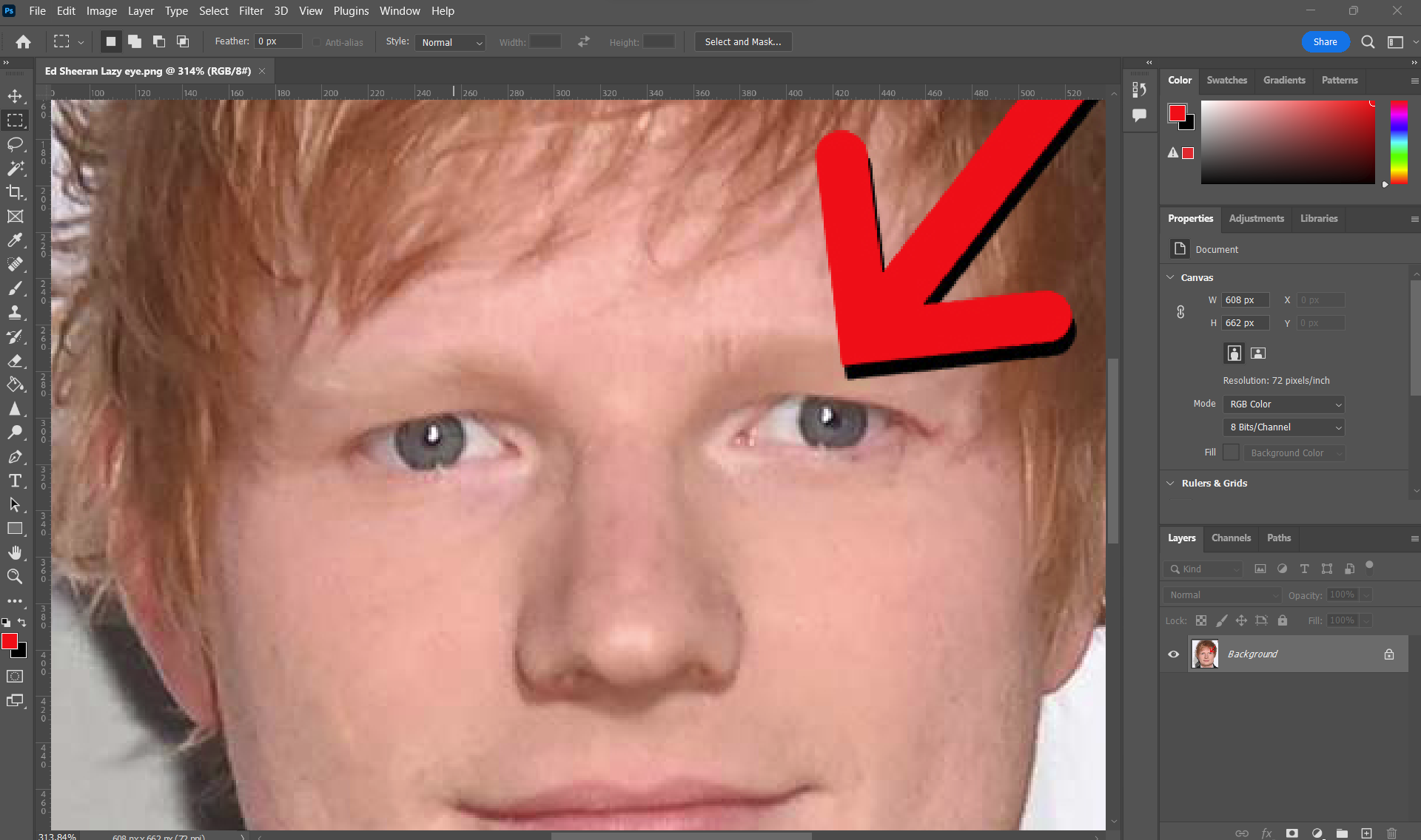 Fix Lazy Eye In Pictures