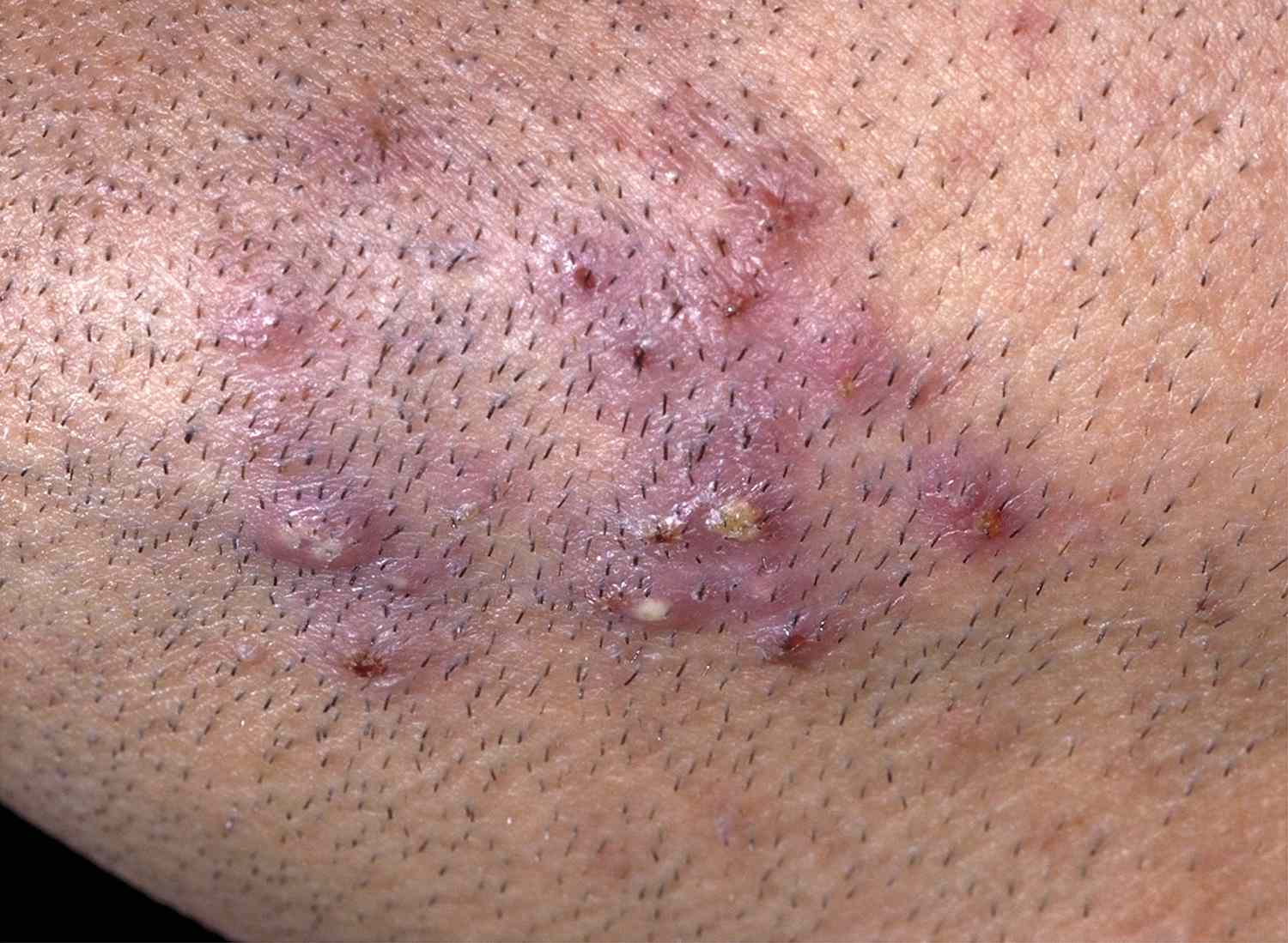 Eingewachsene Haare entfernen und vorbeugen wie man eingewachsene Haare verhindern kann