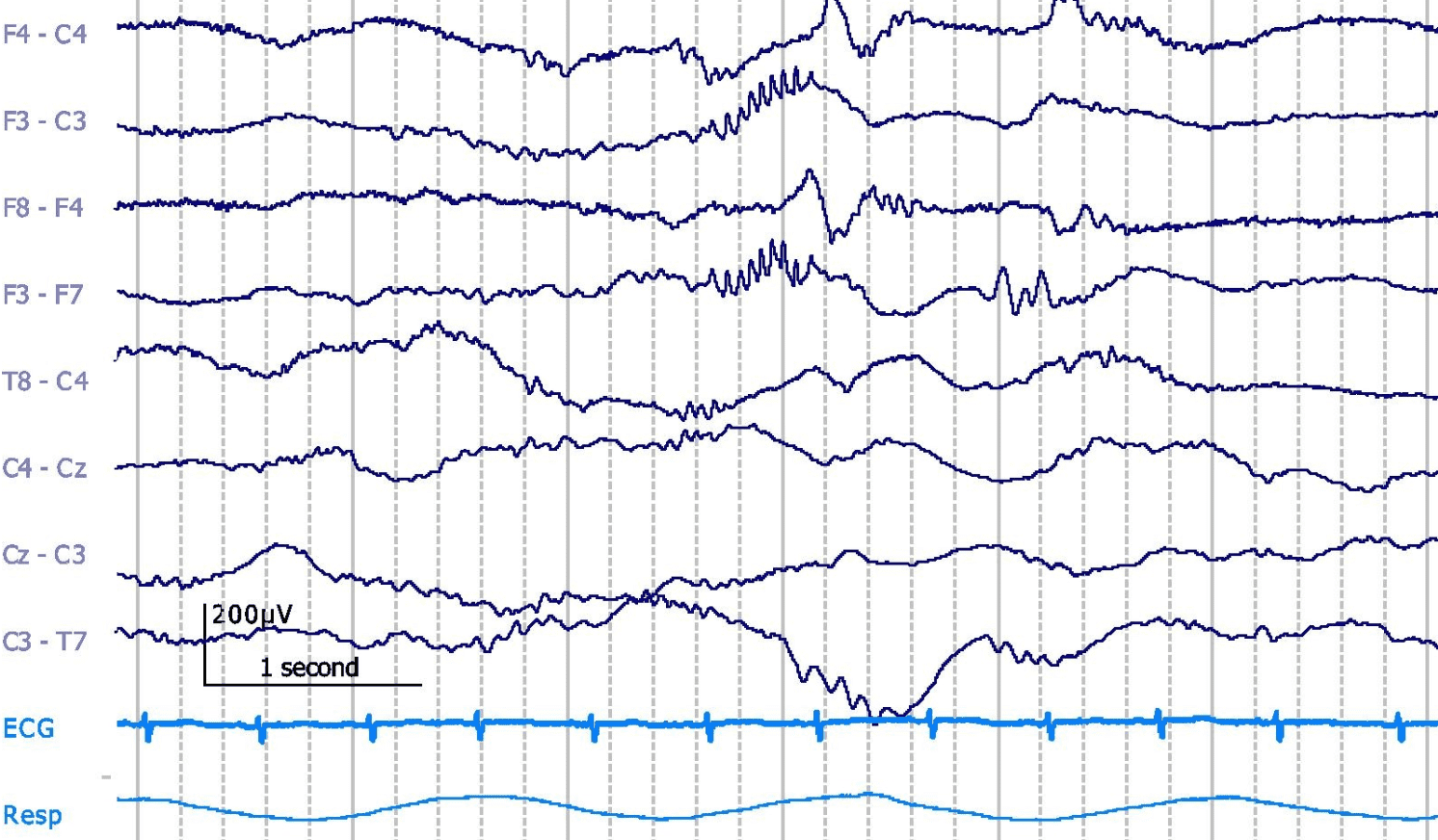 EEG Fun Facts: Delta Brush | Aug 25, 2023