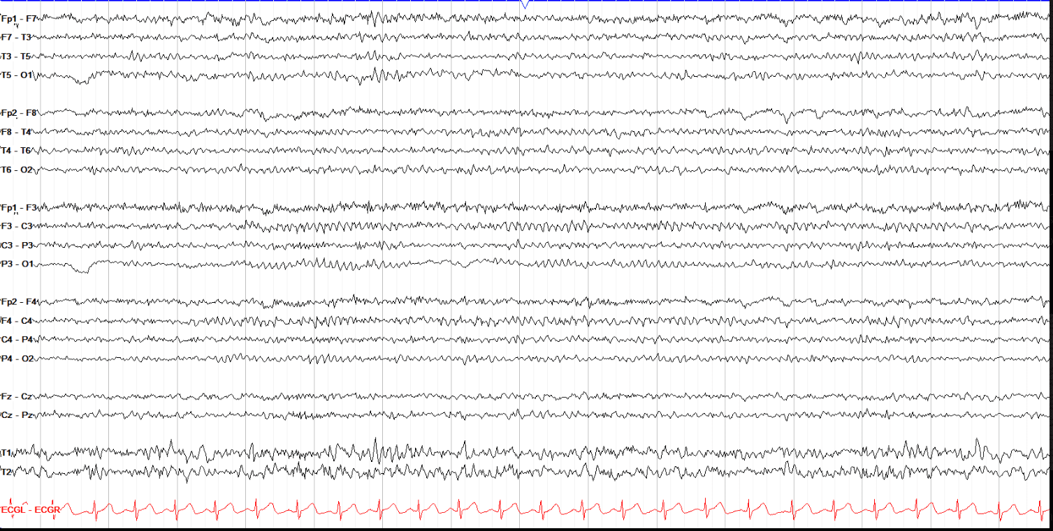EEG Fun Facts: Mu Rhythm | Apr 07, 2023