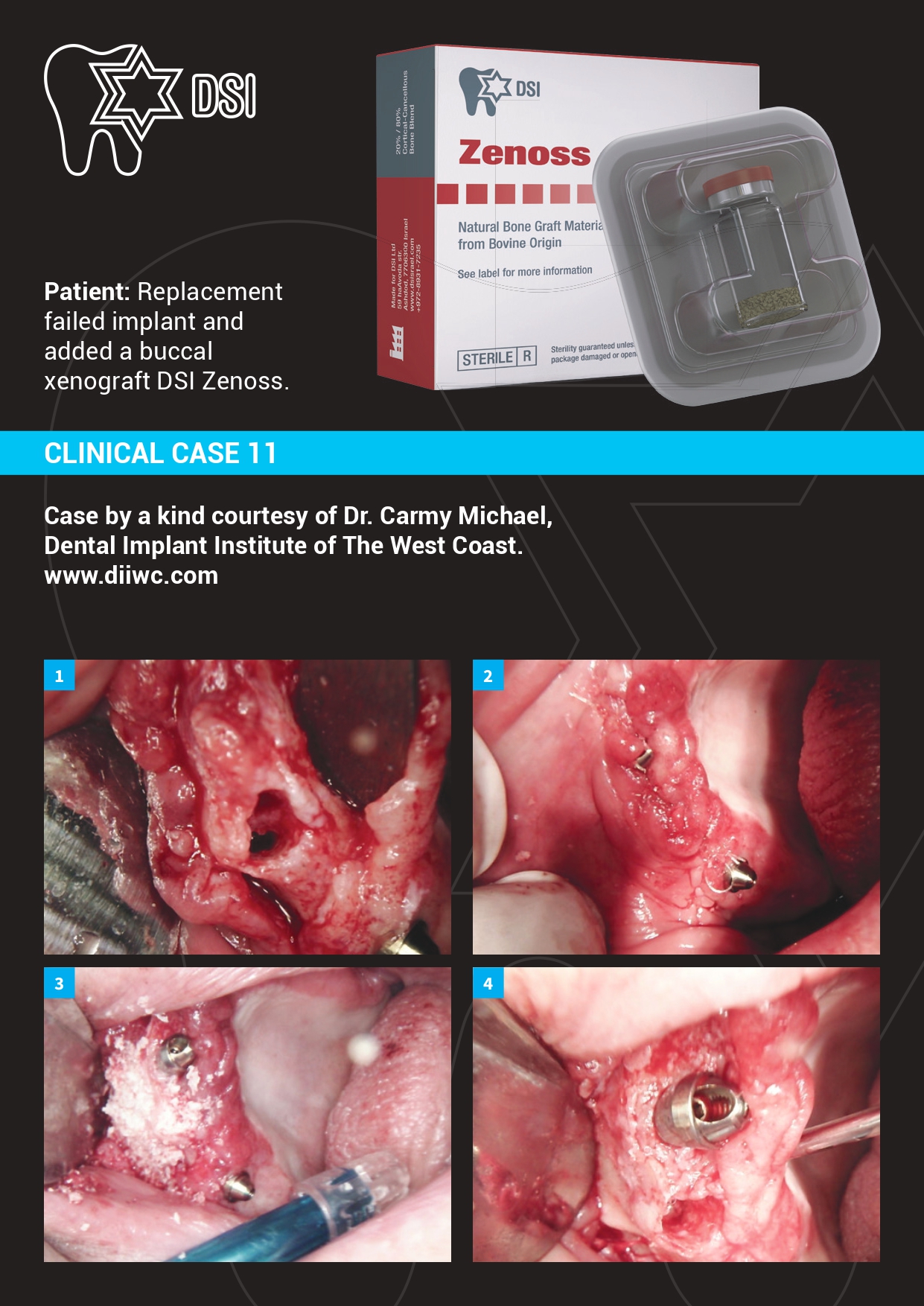 Case Study Replacement failed implant with buccal DSI Zenoss Xenograft