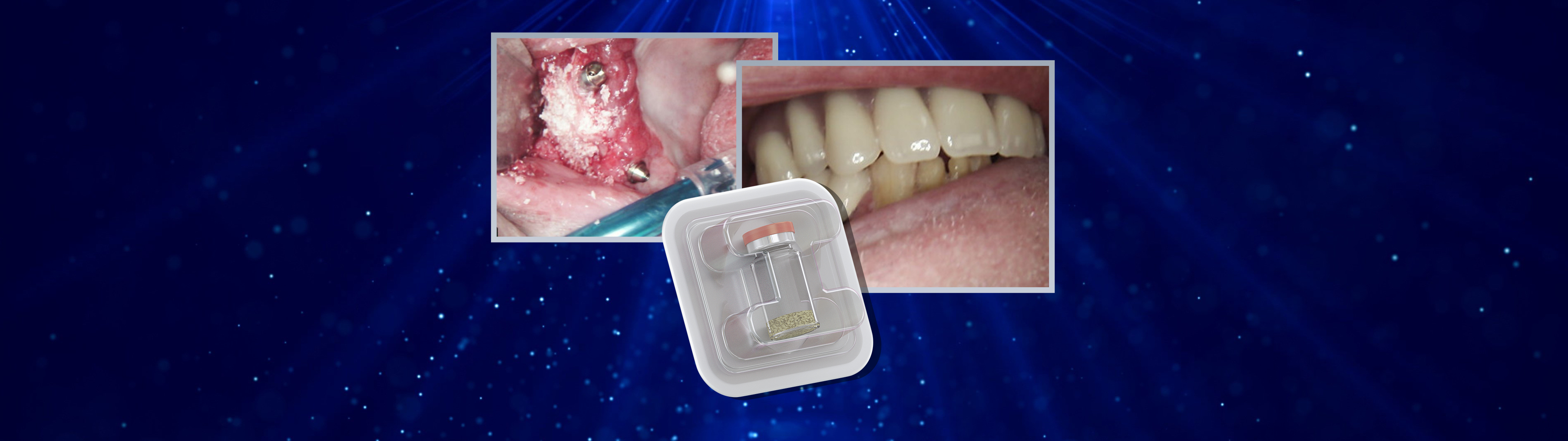 Case Study Replacement failed implant with buccal DSI Zenoss Xenograft