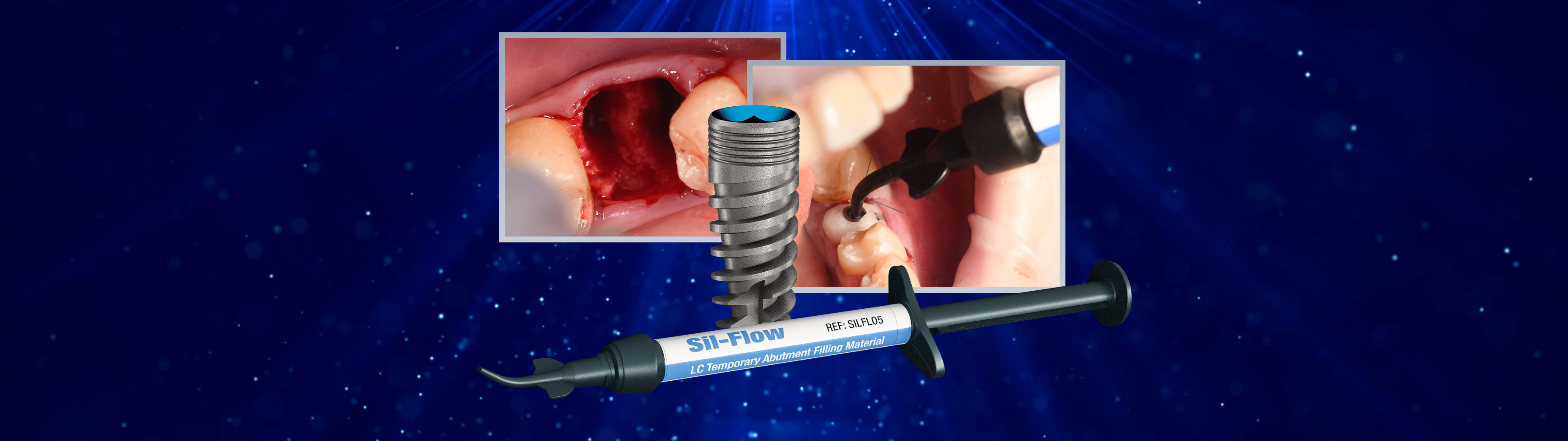 Case Study Sealing Socket Abutment Technique Immediate Implant