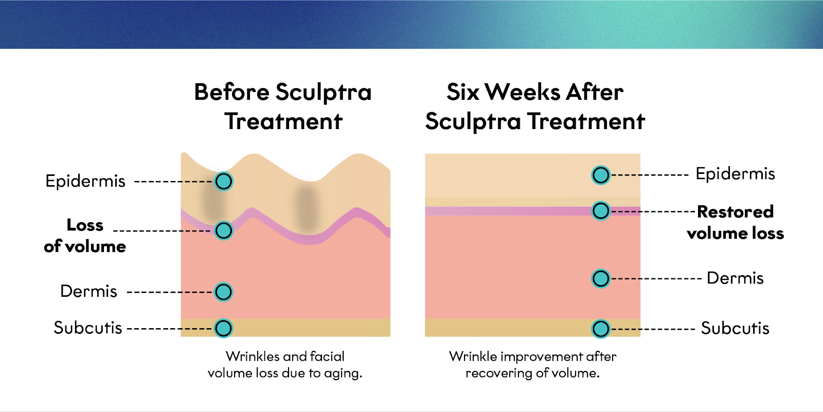 What Is Sculptra®?