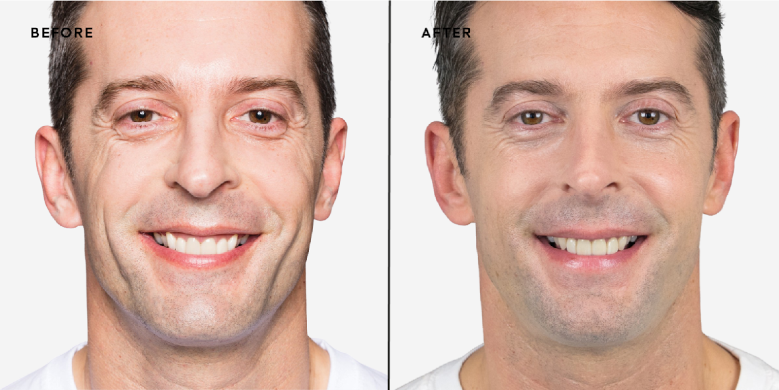 What Is Sculptra®?