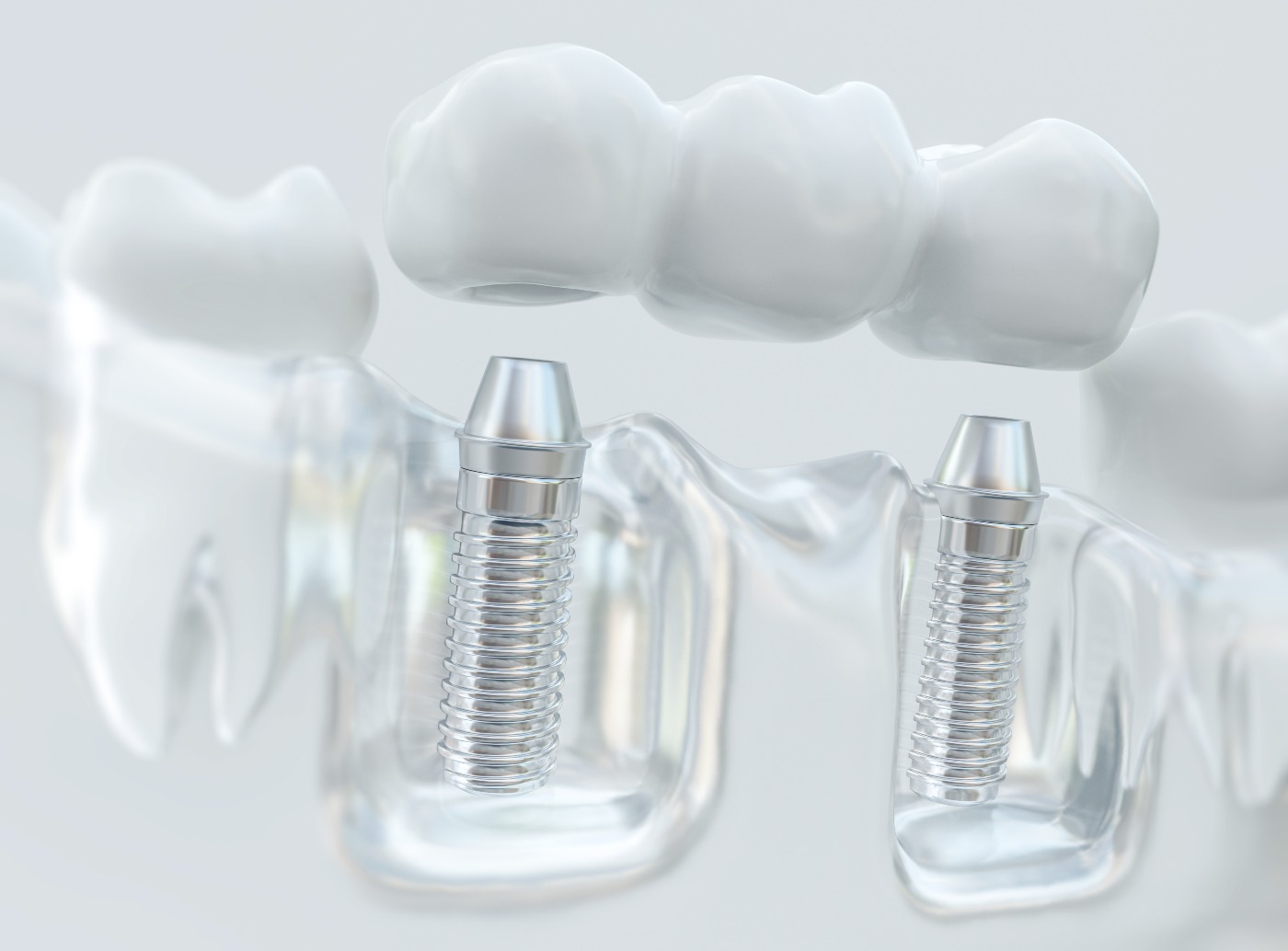 Dental Implants