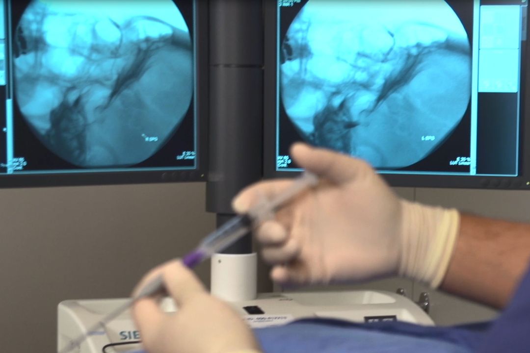 SphenoCath SPG Block in Lincoln, NE - Advanced Medical Imaging