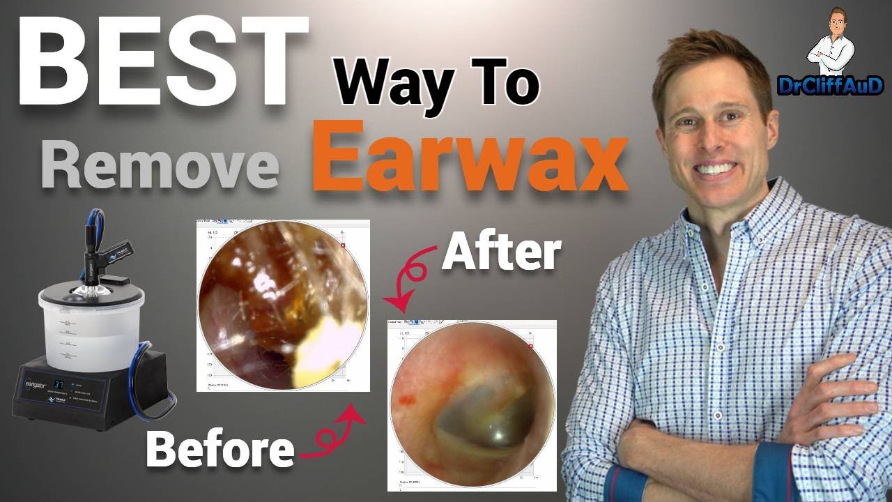 La MEJOR manera de eliminar el cerumen de manera profesional | Earigator Cerumen Irrigation