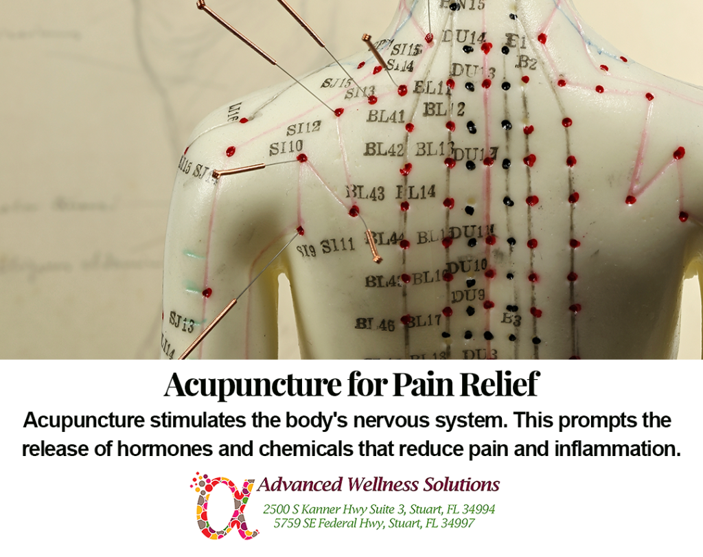 Acupuncture for pain management