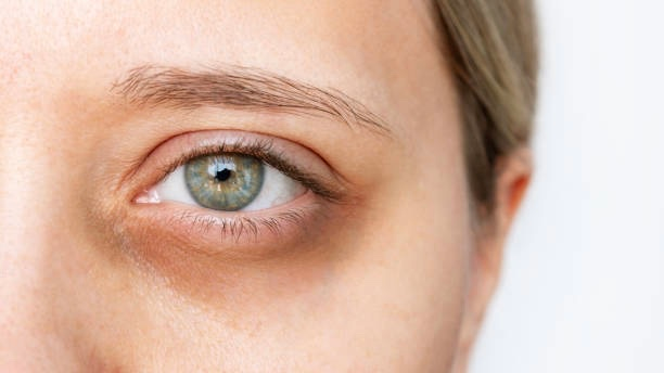 Panda Eyes: Reasons Behind Dark Circles