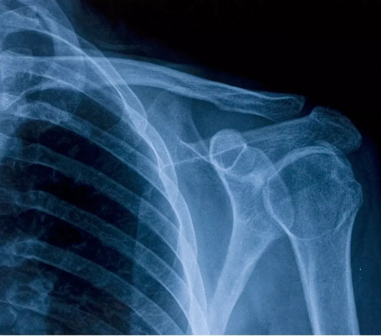An x-ray of an osteoporotic patient.