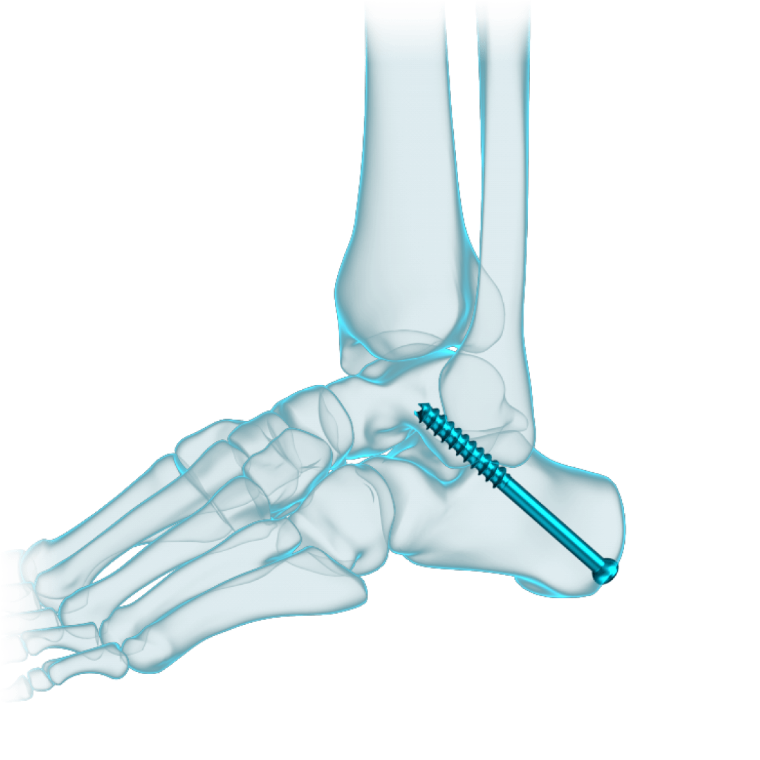 Cannulated Bone Screw with Faceted Technology restor3d