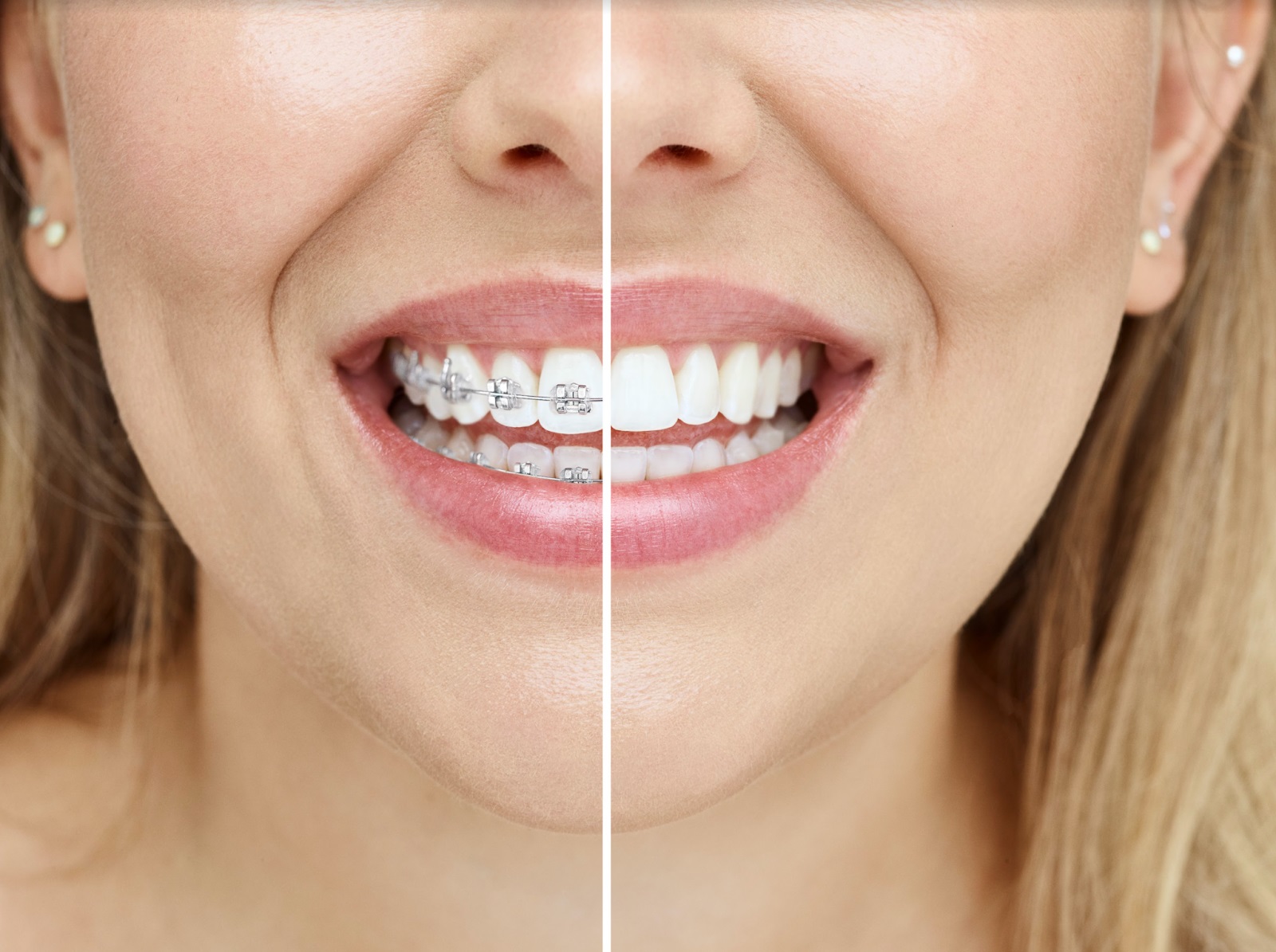 Invisalign vs Braces Pros and Cons