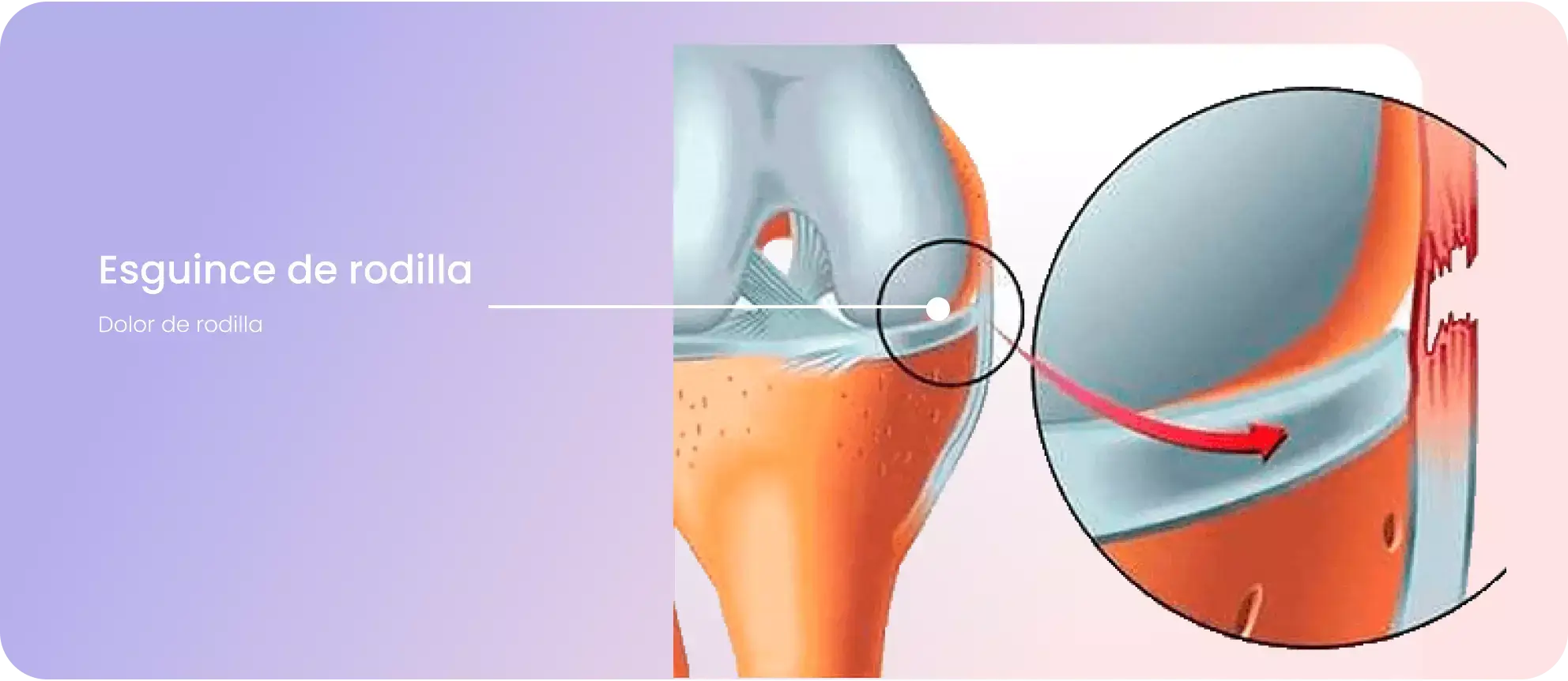 esguince-de-rodilla