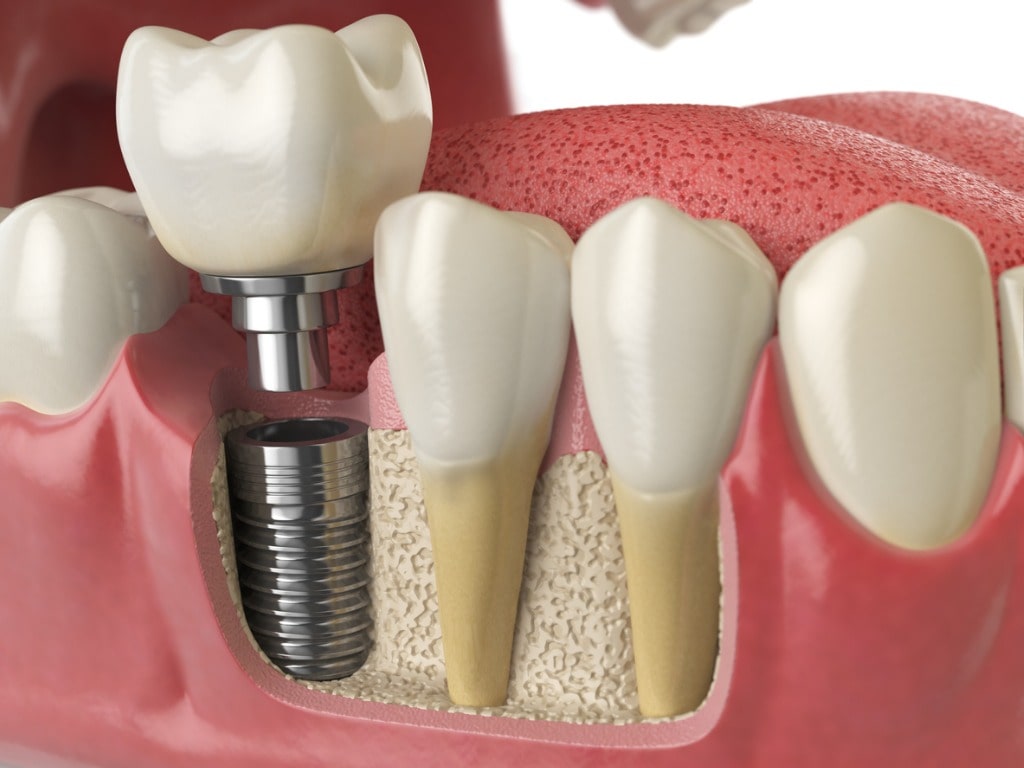 Dental Implants Auckland Family Dental