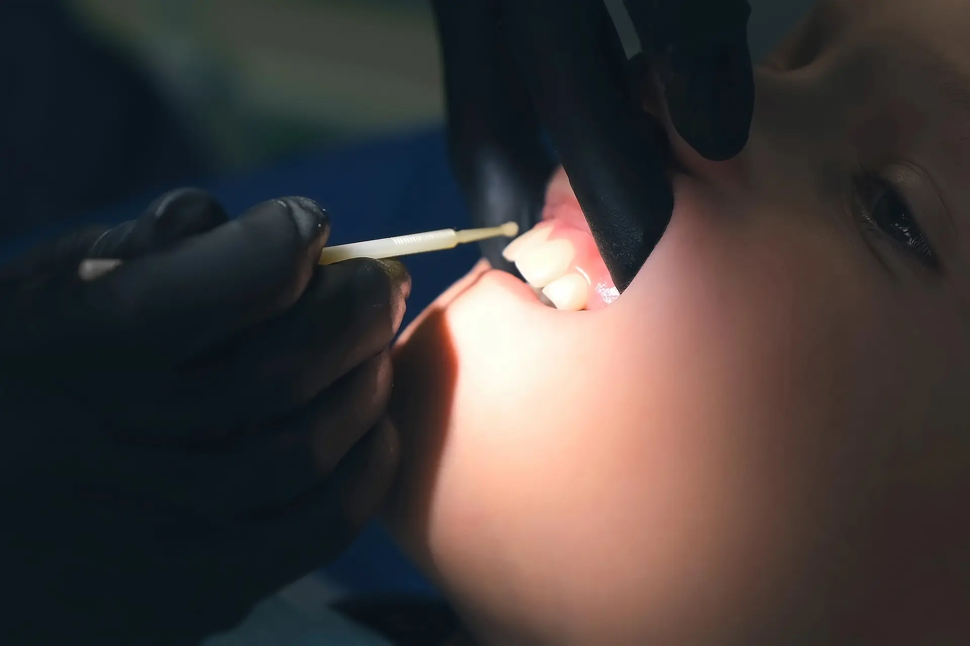 Silver Diamine Fluoride In San Antonio | Alamo Heights