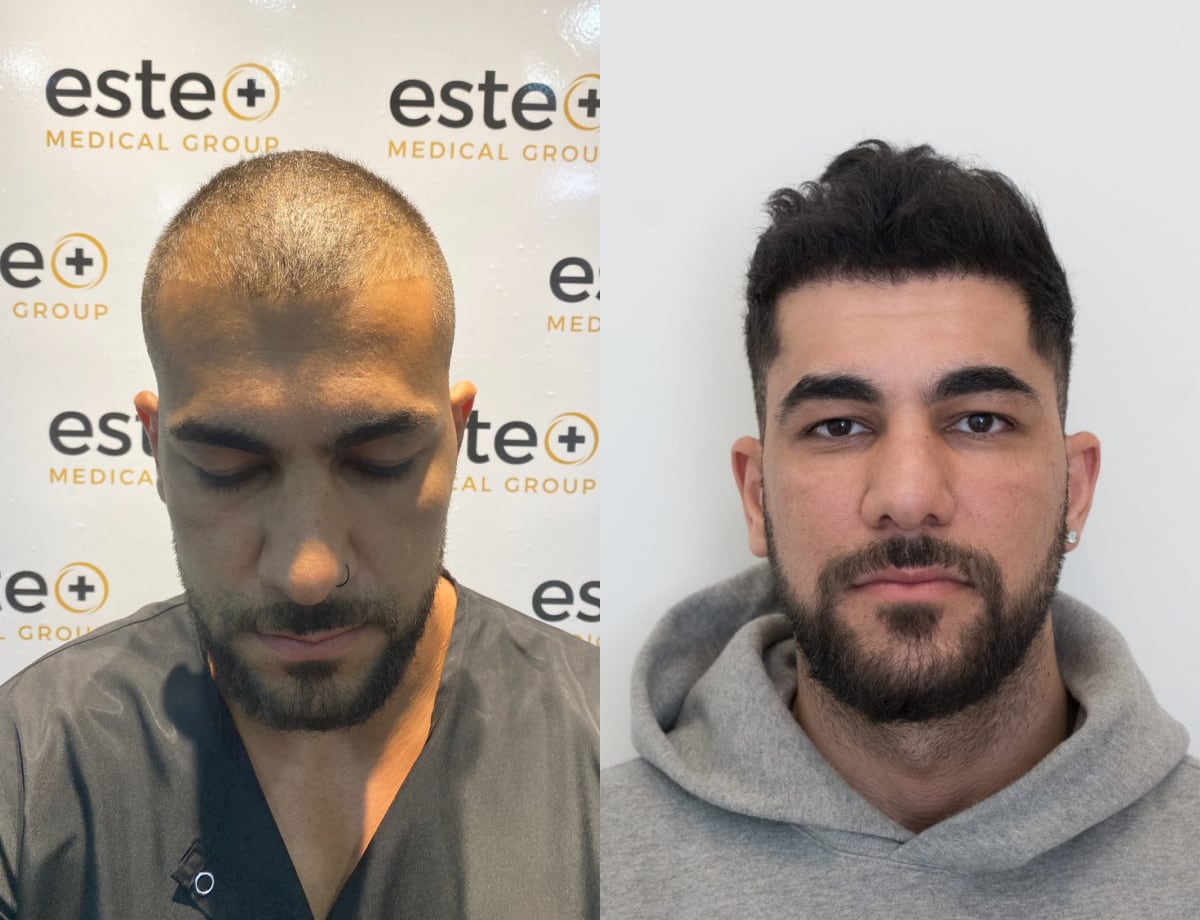 FUE Hair Transplant Results