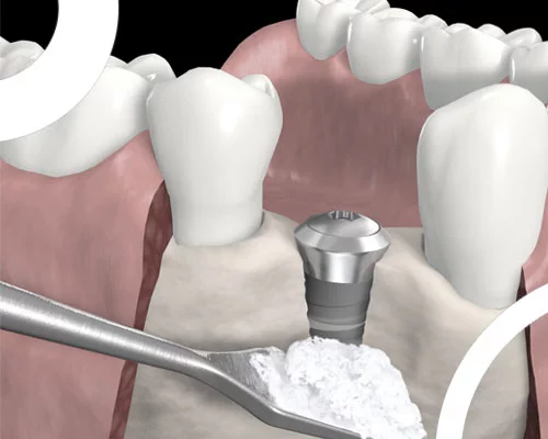 Kit Mini Système GBR Régénération Osseuse Guidée - Chirurgie Dentaire - Israël