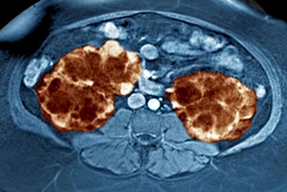Kidney Disease